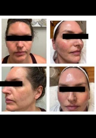 TriBella treatment client result